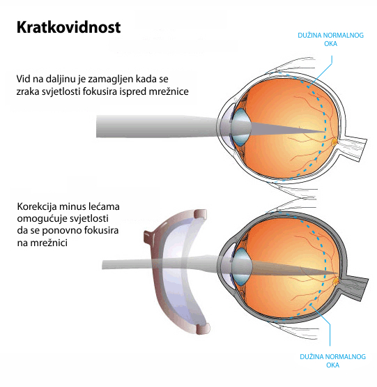 Kratkovidnost