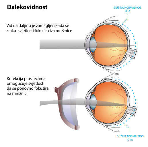Dalekovidnost